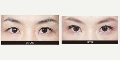 Double Eyelid Surgery before and after photo