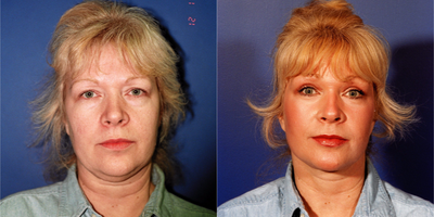 Facelift before and after photo