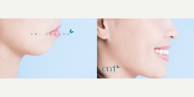 Jaw Surgery before and after photo