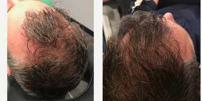 PRP for Hair Loss before and after photo