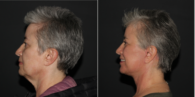 Facelift before and after photo