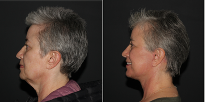 Facelift before and after photo