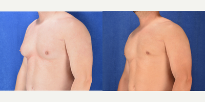 Gynecomastia Surgery before and after photo