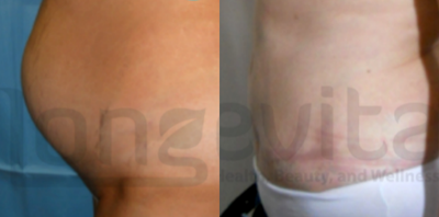 Tummy Tuck before and after photo