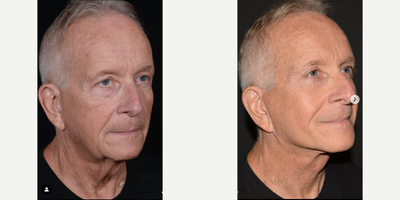 Eyelid Surgery before and after photo