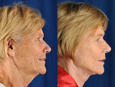 Facelift before and after photo