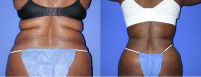 Liposuction before and after photo