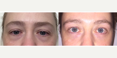 Nonsurgical Facelift before and after photo