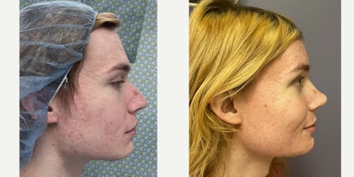 Brow Lift before and after photo