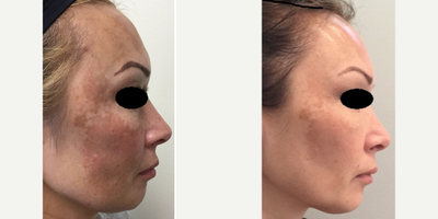 DefenAge before and after photo