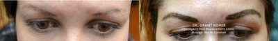 Eyebrow Transplant before and after photo
