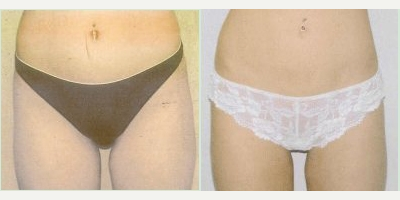 Liposuction before and after photo