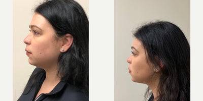 Smart Lipo before and after photo