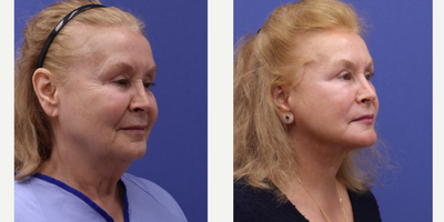CO2 Laser before and after photo