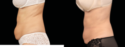 Emsculpt before and after photo