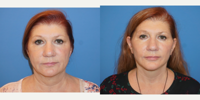 Lower Facelift before and after photo