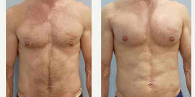 Pec Implants before and after photo