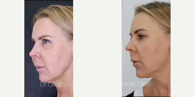 Thread Lift before and after photo