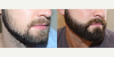 Beard Transplant before and after photo