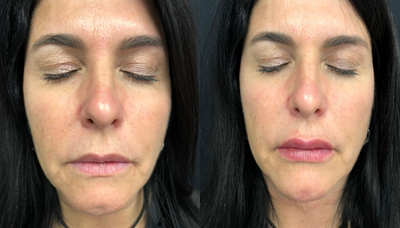 Restylane Silk before and after photo