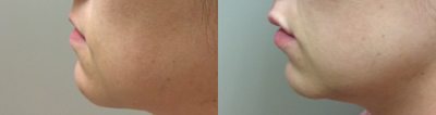 Dermal Fillers before and after photo
