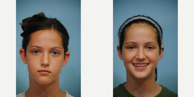 Ear Surgery before and after photo