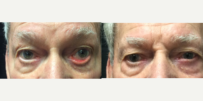 Eyelid Surgery before and after photo