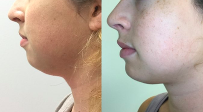 Kybella before and after photo