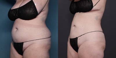 Liposuction before and after photo