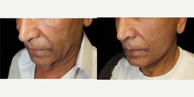 Mini Facelift before and after photo