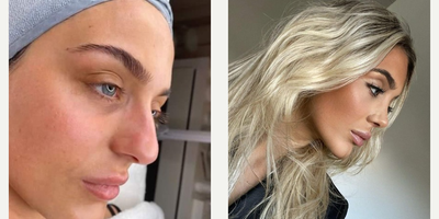 Rhinoplasty before and after photo