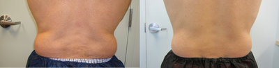 CoolSculpting before and after photo