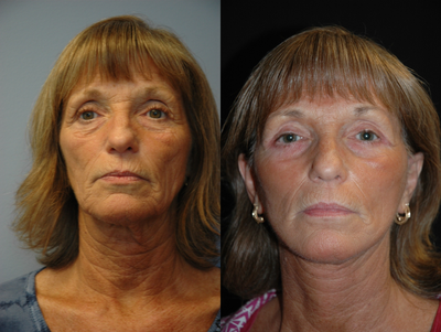 Facelift before and after photo