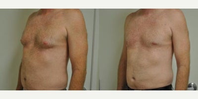 Gynecomastia Surgery before and after photo
