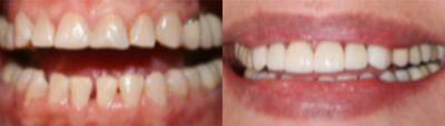 Dental Bridge before and after photo