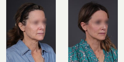 Facelift before and after photo
