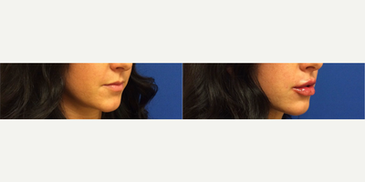 Juvederm before and after photo