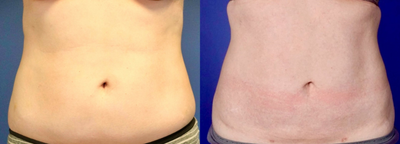 Liposuction before and after photo
