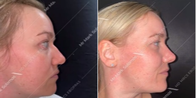Rhinoplasty before and after photo