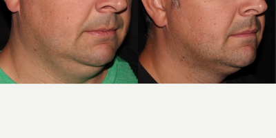 CoolSculpting before and after photo
