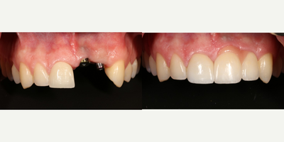 Dental Implants before and after photo