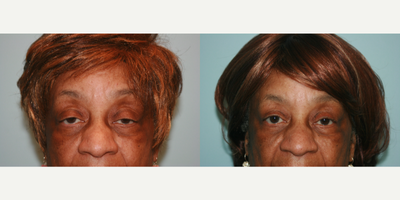 Eyelid Surgery before and after photo