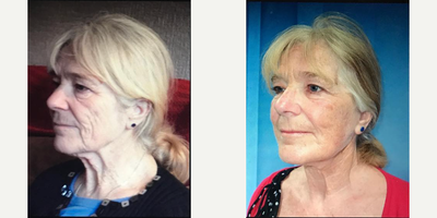 Facelift before and after photo