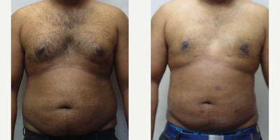 Gynecomastia Surgery before and after photo