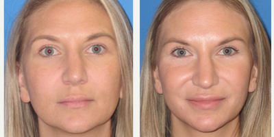 Juvederm before and after photo