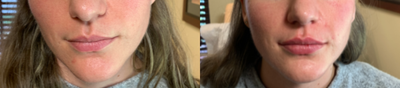 Juvederm before and after photo