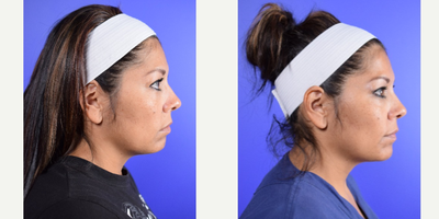 Liquid Facelift before and after photo