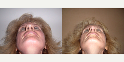 Revision Rhinoplasty before and after photo