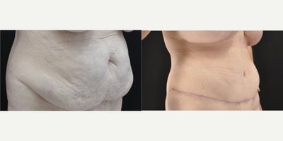 Tummy Tuck before and after photo