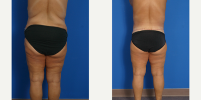 Body Lift before and after photo